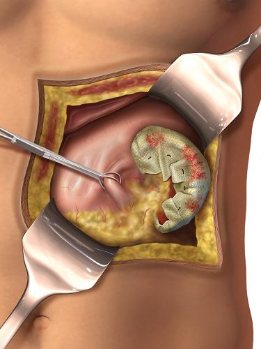 Over kisti Patlojileri Over kisti Patlojileri
