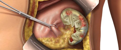 Over kisti Patlojileri