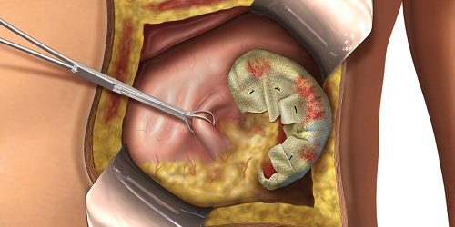 Over kisti Patlojileri
