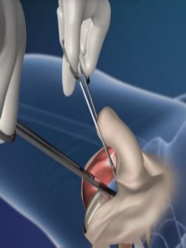 Penis Kalınlaştırma Ameliyatı Penis Kalınlaştırma Ameliyatı