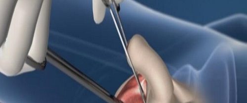 Penis Kalınlaştırma Ameliyatı