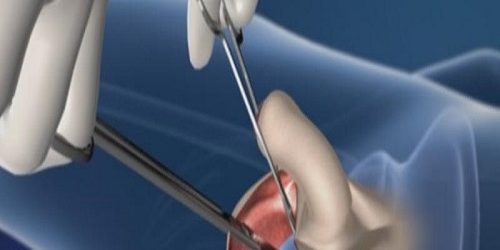 Penis Kalınlaştırma Ameliyatı