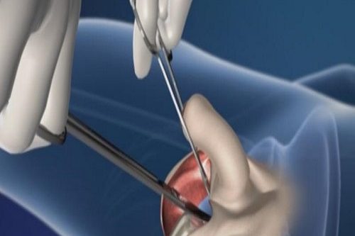 Penis Kalınlaştırma Ameliyatı