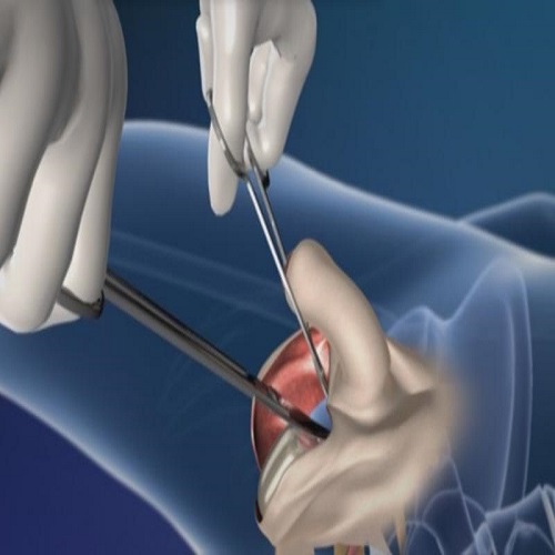 Penis Kalınlaştırma Ameliyatı