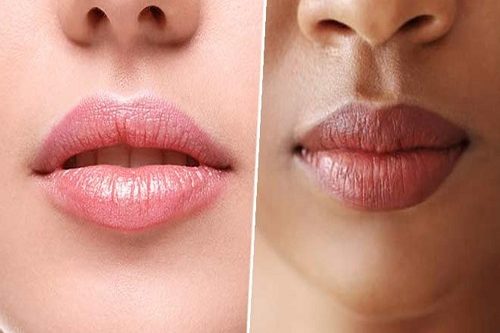 Permalip Dudak Silikonu