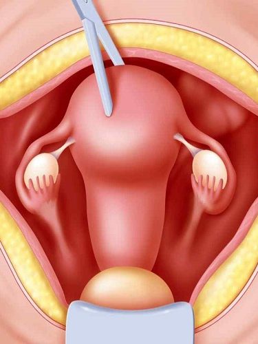 Rektosel Ameliyatı Rektosel Ameliyatı