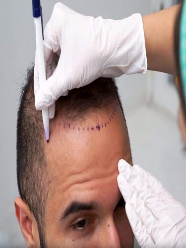 Saç Ekimi Saç Ekimi