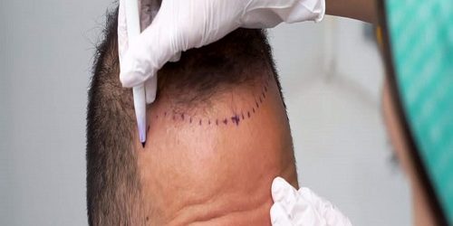 Saç Ekimi Saç Ekimi