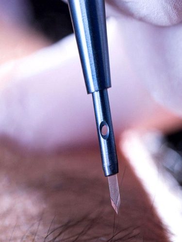 Safir Saç Ekimi Safir Saç Ekimi