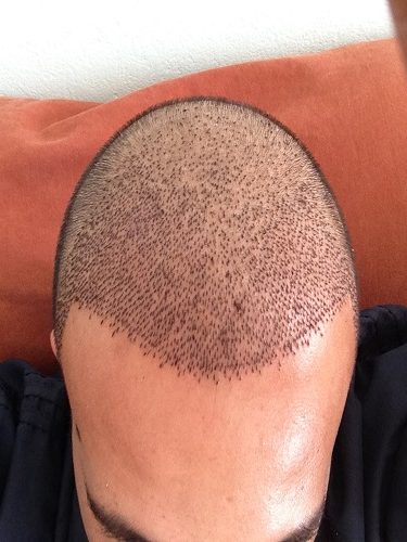 Sedasyonlu Saç Ekimi Sedasyonlu Saç Ekimi