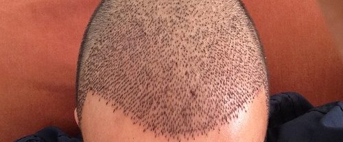 Sedasyonlu Saç Ekimi