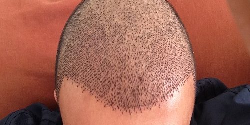 Sedasyonlu Saç Ekimi Sedasyonlu Saç Ekimi