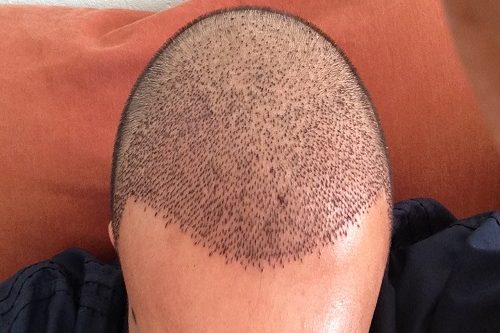 Sedasyonlu Saç Ekimi