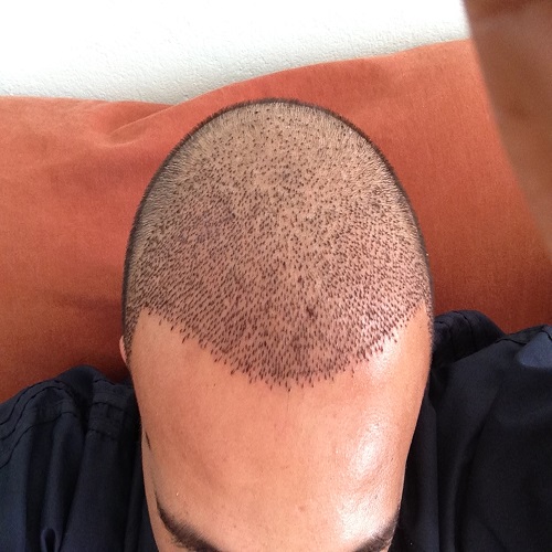 Sedasyonlu Saç Ekimi