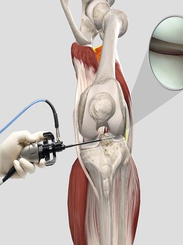 Artroskopik Menisküs Onarımı Artroskopik Menisküs Onarımı