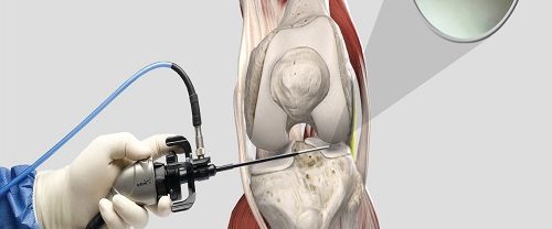 Artroskopik Menisküs Onarımı