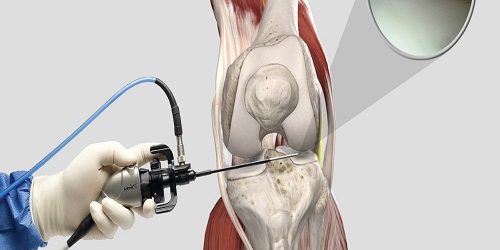 Artroskopik Menisküs Onarımı