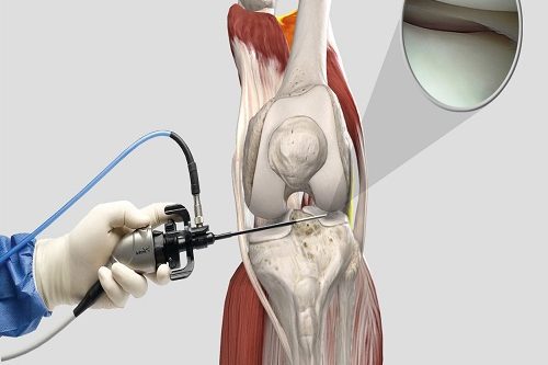 Artroskopik Menisküs Onarımı