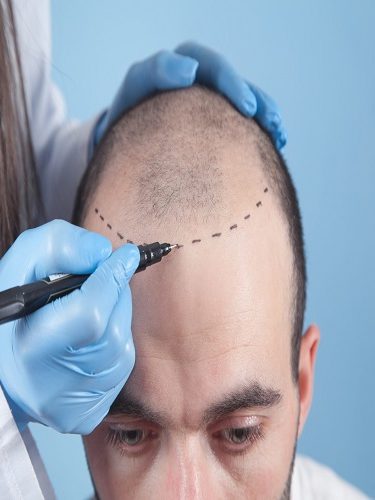 TDF Saç Ekimi TDF Saç Ekimi