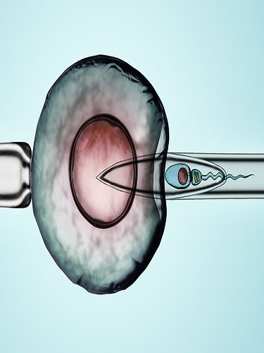 TESE VE MİKRO-TESE TESE ve Mikro-TESE