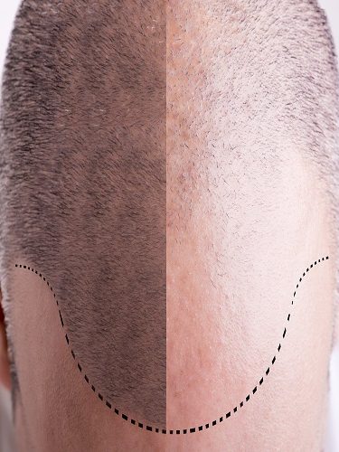 Tıraşsız Saç Ekimi Tıraşsız Saç Ekimi