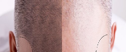 Tıraşsız Saç Ekimi