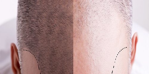 Tıraşsız Saç Ekimi Tıraşsız Saç Ekimi