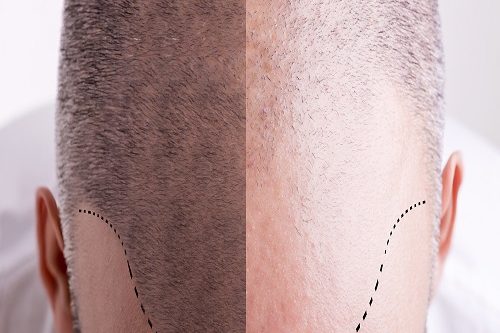 Tıraşsız Saç Ekimi