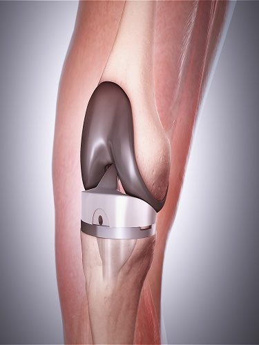 Total Diz Protezi Total Diz Protezi