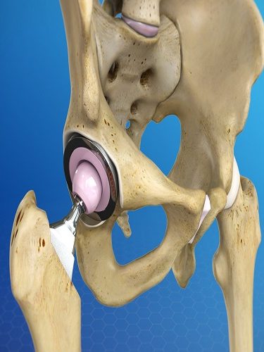 Total Kalça Protezi Replasmanı Total Kalça Protezi Replasmanı