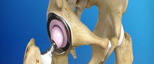 Total Kalça Protezi Replasmanı