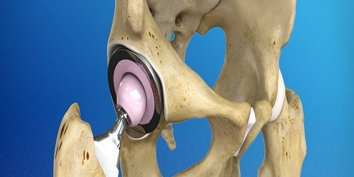 Total Kalça Protezi Replasmanı