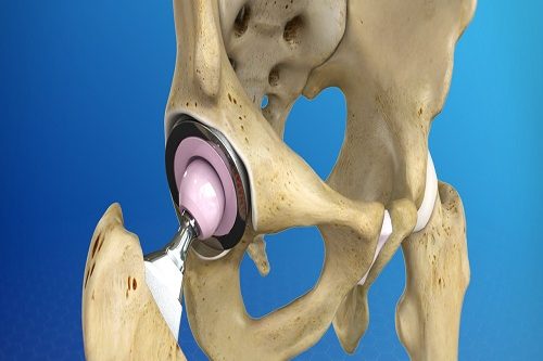 Total Kalça Protezi Replasmanı