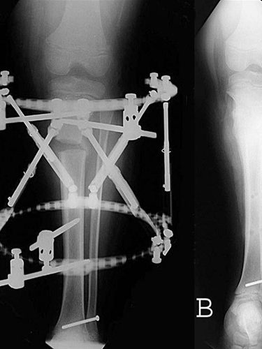 İlizarov Yöntemi İlizarov Yöntemi