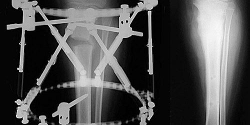 İlizarov Yöntemi İlizarov Yöntemi