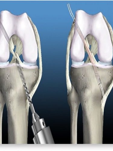 Transfix Tekniği Transfix Tekniği