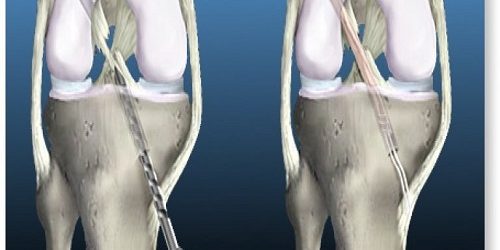 Transfix Tekniği Transfix Tekniği