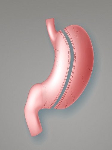 Tüp Mide Ameliyatı Tüp Mide Ameliyatı