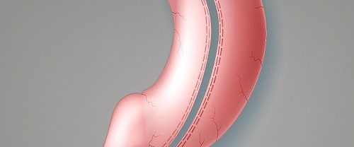 Tüp Mide Ameliyatı