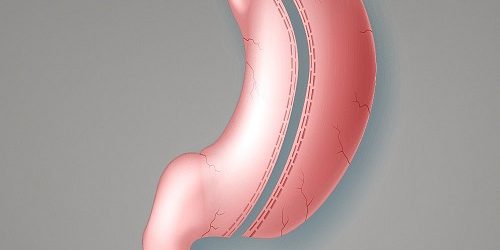Tüp Mide Ameliyatı Tüp Mide Ameliyatı
