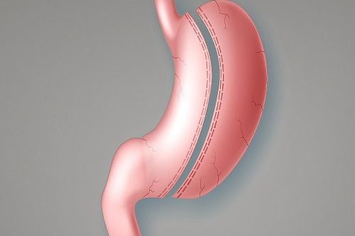 Tüp Mide Ameliyatı