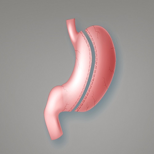 Tüp Mide Ameliyatı