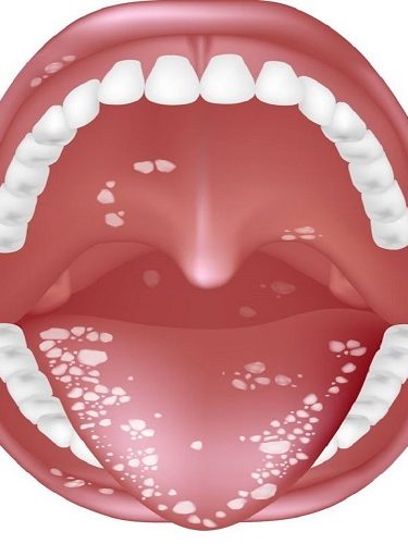 Uvulopalatoplasti Küçük Dil Kısaltılması Uvulopalatoplasti Küçük Dil Kısaltılması