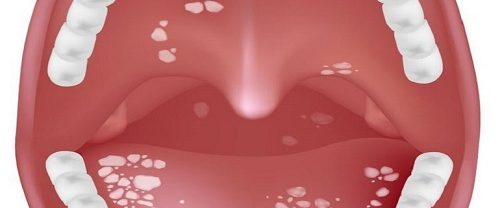 Uvulopalatoplasti Küçük Dil Kısaltılması