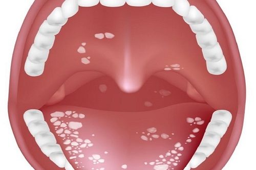 Uvulopalatoplasti Küçük Dil Kısaltılması