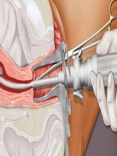 Vakumlu Aspirasyon Yöntemi İle Kürtaj Vakumlu Aspirasyon Yöntemi İle Kürtaj