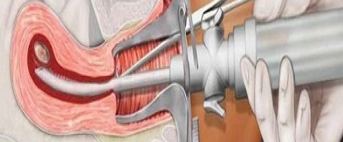 Vakumlu Aspirasyon Yöntemi İle Kürtaj