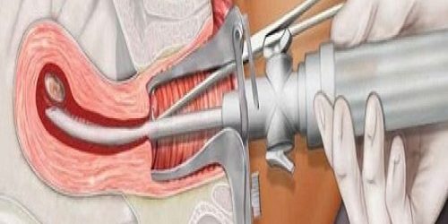 Vakumlu Aspirasyon Yöntemi İle Kürtaj