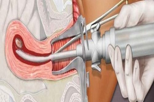 Vakumlu Aspirasyon Yöntemi İle Kürtaj