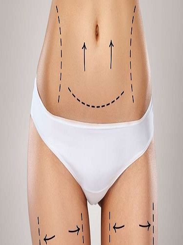 Vaser Liposuction Vaser Liposuction